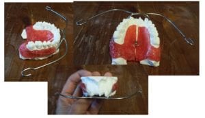 facepulling appliance intra oral