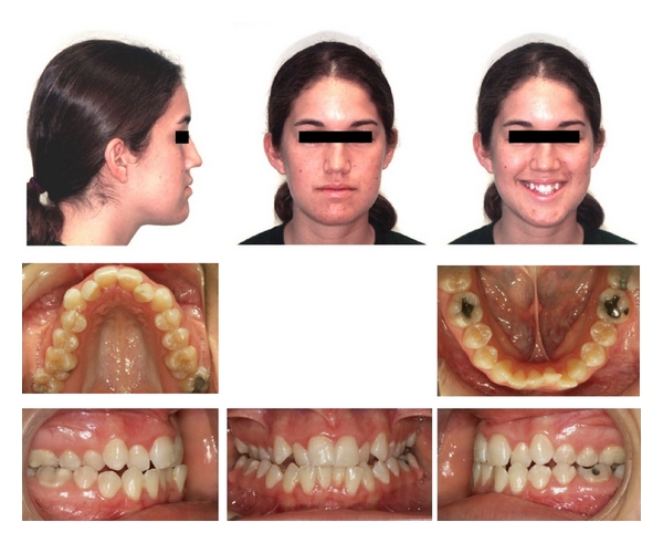 Palate Expander Adults Before And After