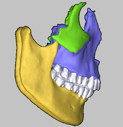 Recessed Maxilla Before And After Face Pulling Results On Adults