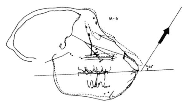 Recessed Maxilla Before And After Face Pulling Results On Adults