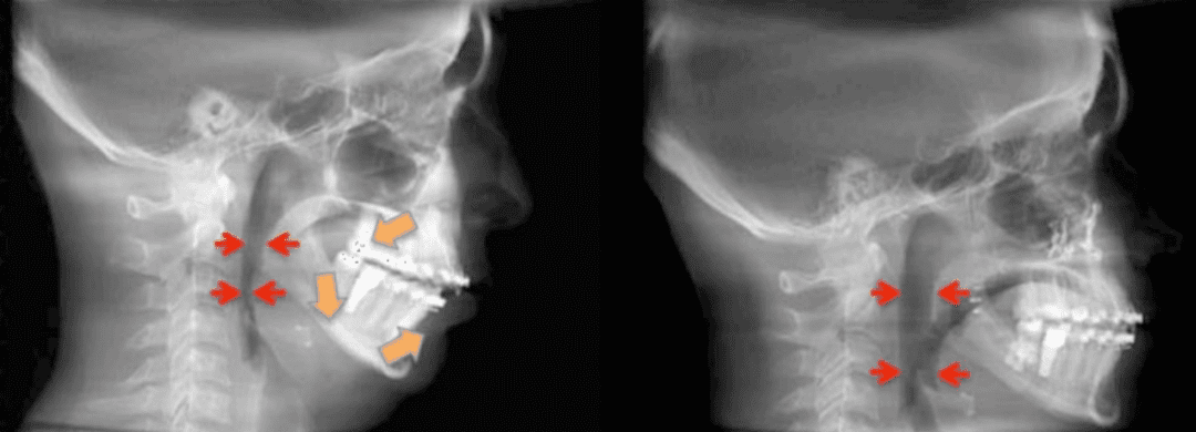 Recessed Maxilla Before And After Face Pulling Results On Adults